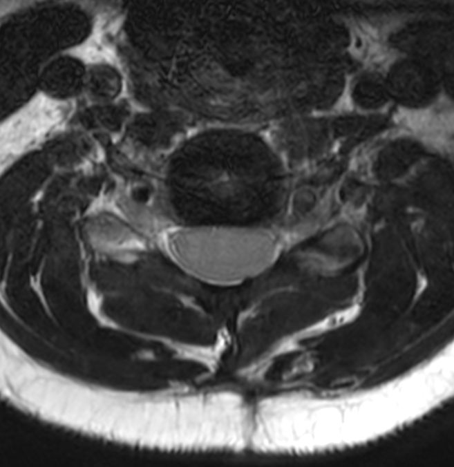 Axial 3D T2w TSE DRIVE