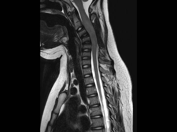 Sagittal T2w TSE (C-Spine)