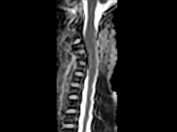 Sagittal Zoom DWI (ADC)