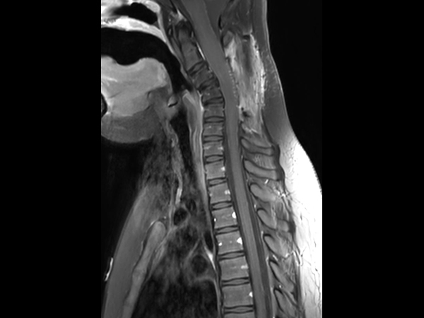 Sagittal T1w TSE SPIR (with gado)