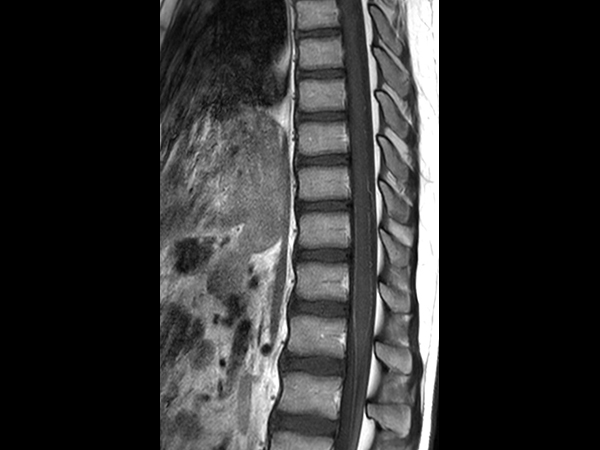 Sagittal T1w TSE mDIXON XD (In Phase) (with gado)