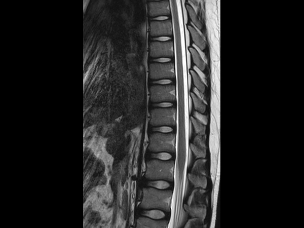 Sagittal T2w TSE (T-Spine)