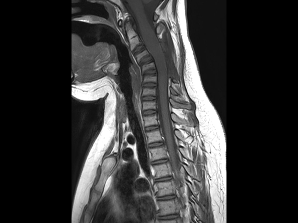 Sagittal T1w TSE (C-Spine)