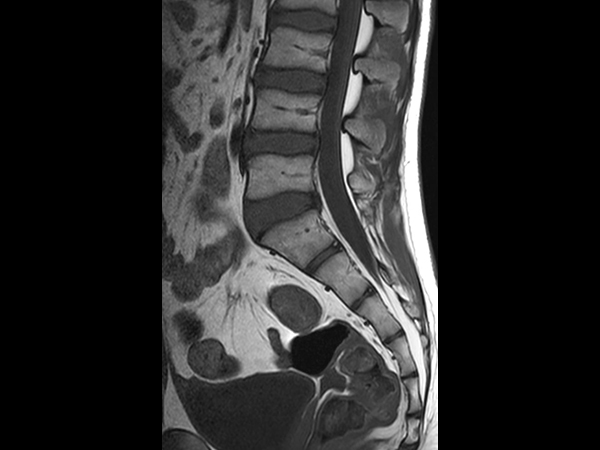 Sagittal T1w TSE (L-Spine)