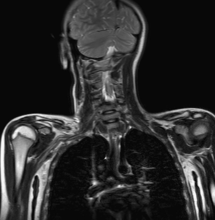 Coronal SSh T2w TSE (upper station)