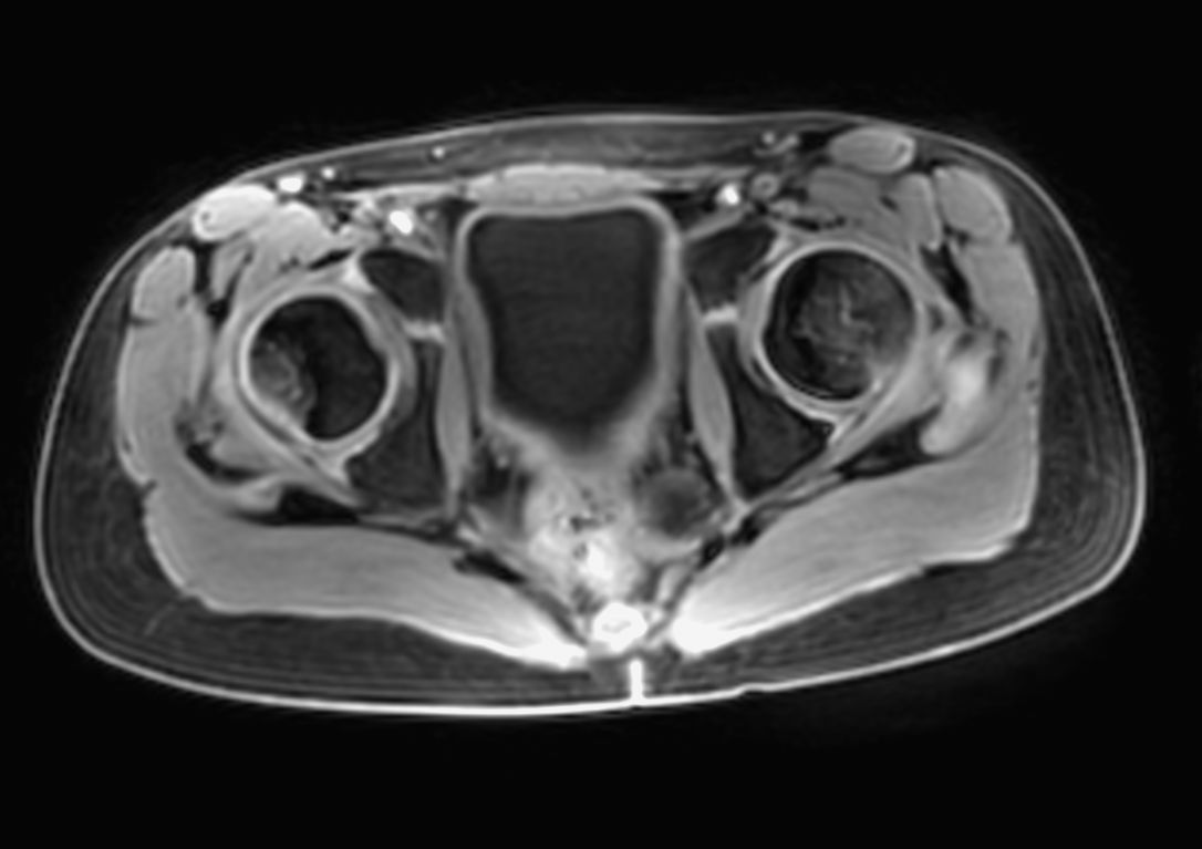 Axial Free Breathing T1w FFE 3D VANE XD (Water only) (lower station)
