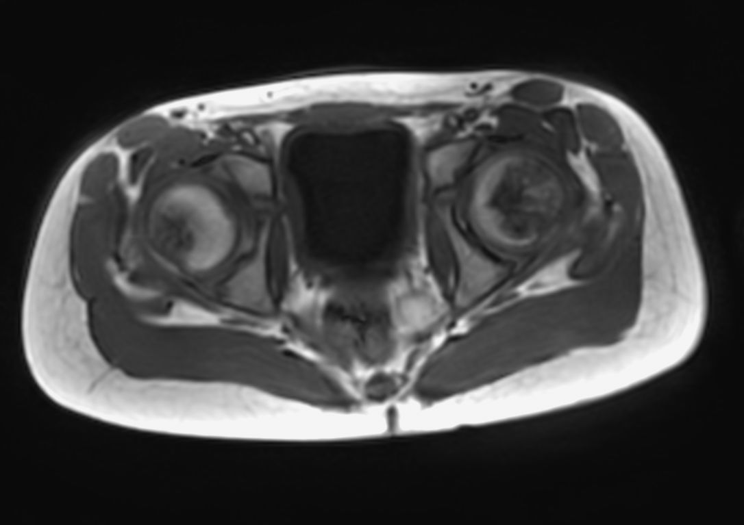 Axial Free Breathing T1w FFE 3D VANE XD (In Phase) (lower station)