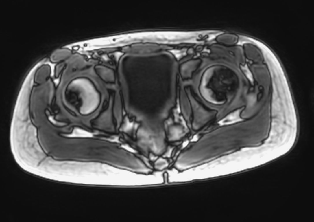 Axial Free Breathing T1w FFE 3D VANE XD (Out Phase) (lower station)