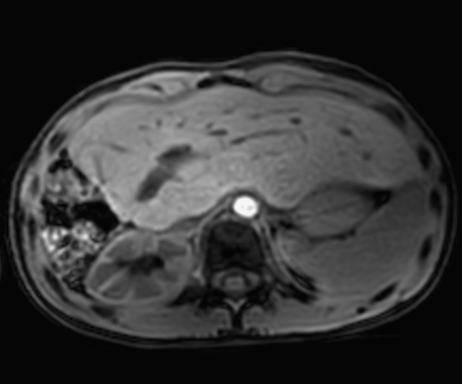 Axial Free Breathing 3D T1w FFE mDIXON XD (Water only) (pre-gado)