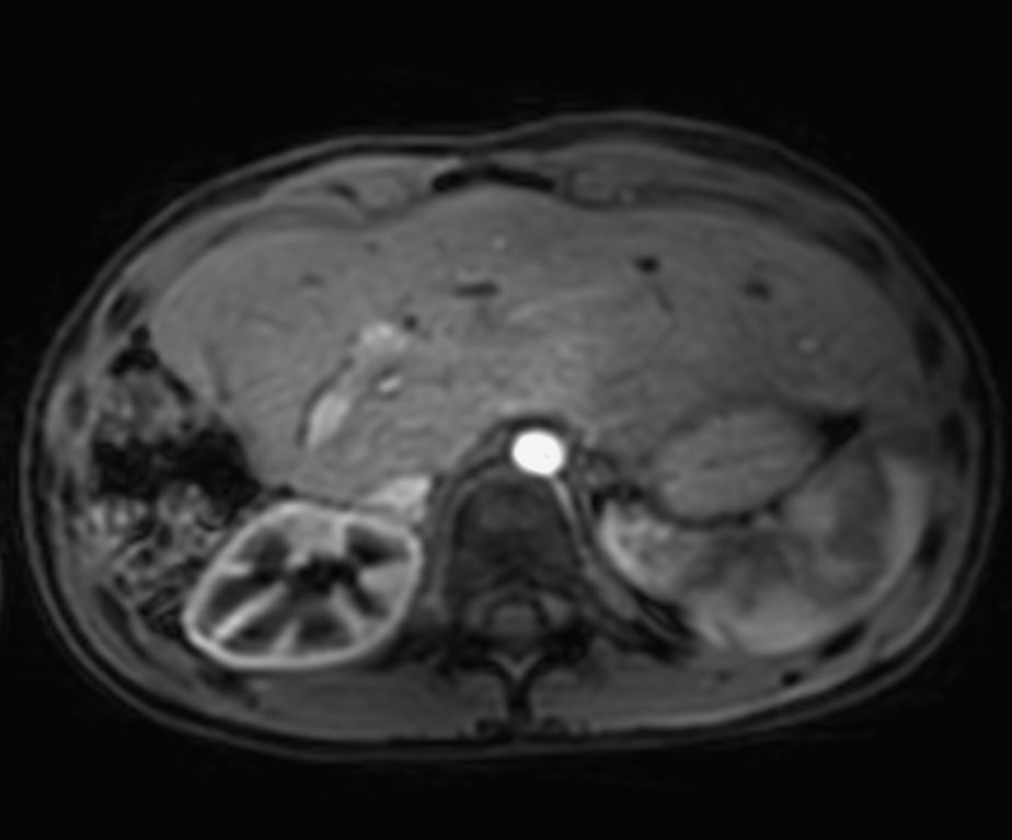 Dynamic Free Breathing 3D T1w FFE mDIXON XD (Water only) (post-gado, early phase)