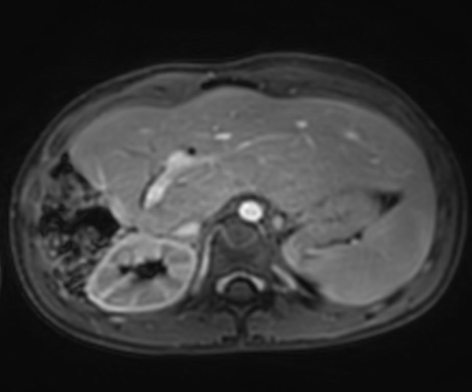 Dynamic Free Breathing 3D T1w FFE mDIXON XD (Water only) (post-gado, late phase)