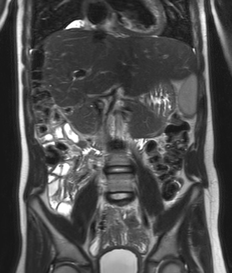 Coronal SSh T2w TSE (middle station)