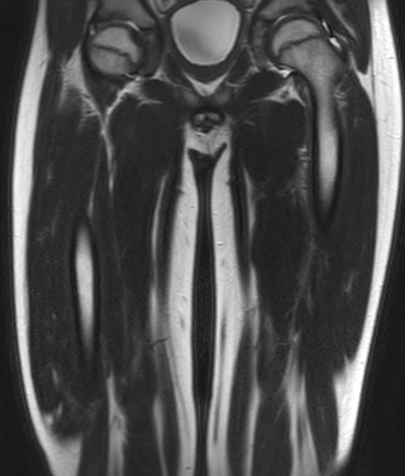 Coronal SSh T2w TSE (lower station)