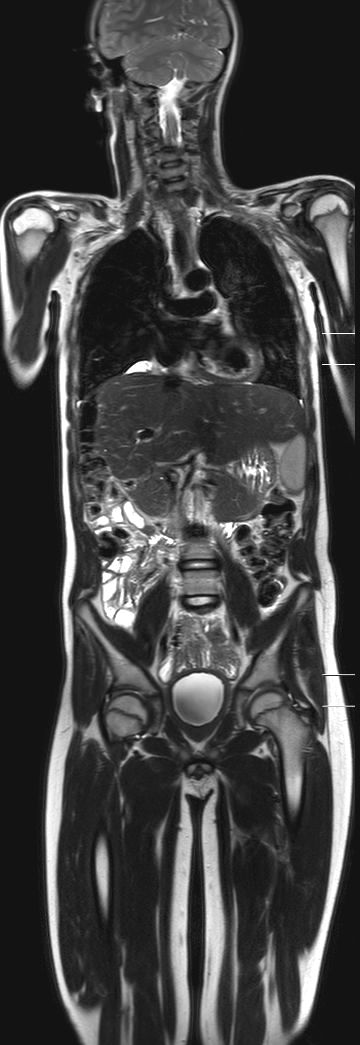 Coronal SSh T2w TSE (MobiView)