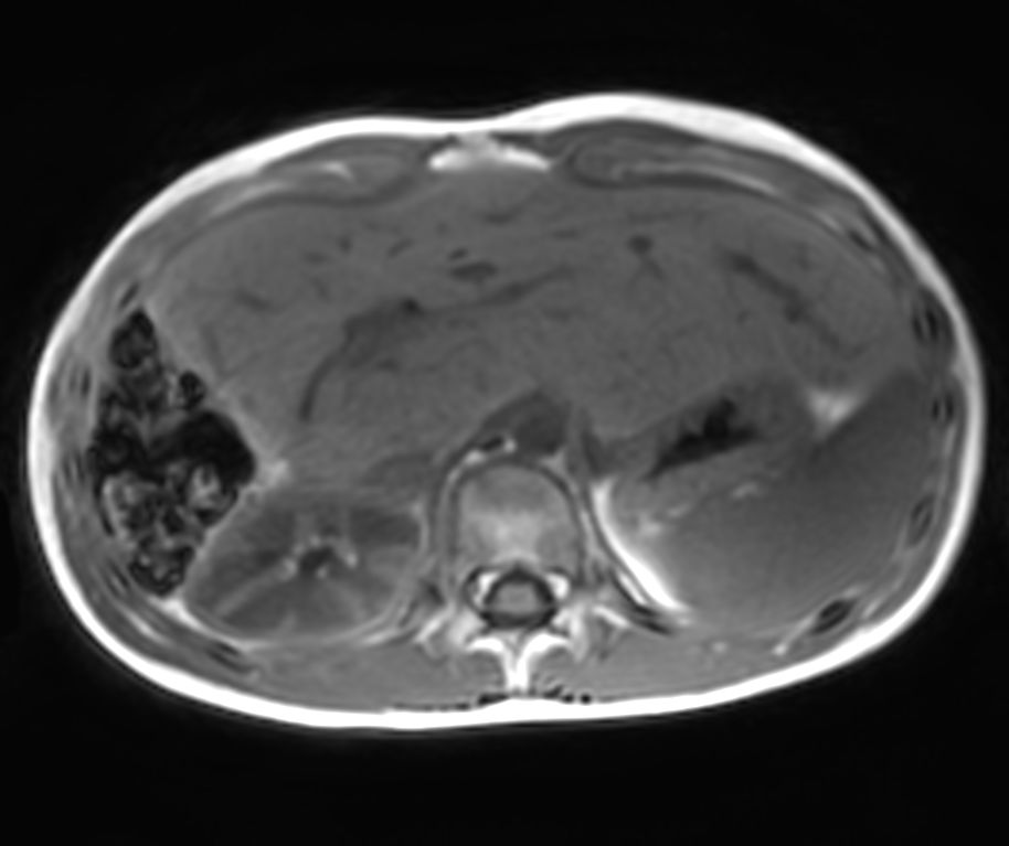 Axial Free Breathing T1w FFE 3D VANE XD (In Phase) (upper station)