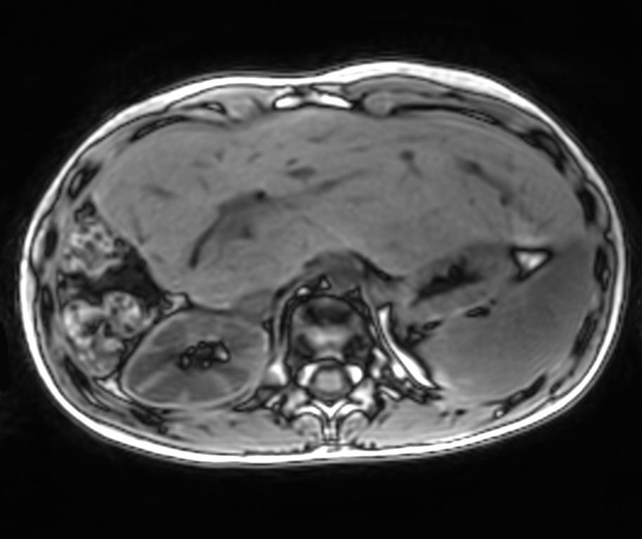 Axial Free Breathing T1w FFE 3D VANE XD (Out Phase) (upper station)