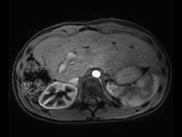 Dynamic Free Breathing 3D T1w FFE mDIXON XD (Water only) (post-gado, early phase)