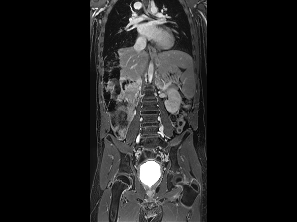 Coronal Free Breathing 3D T1w FFE mDIXON XD (Water only) (post-gado) (MobiView)