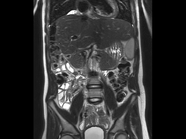 Coronal SSh T2w TSE (middle station)