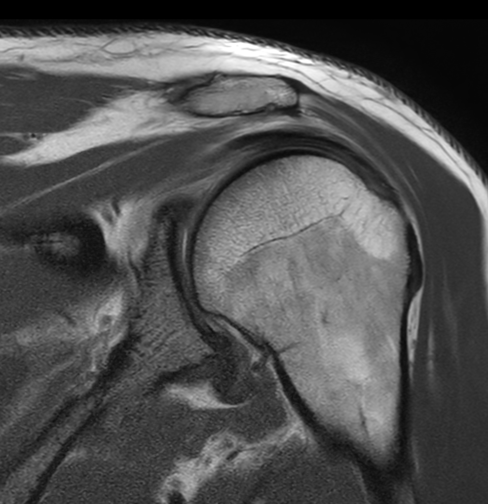 Motion-free shoulder imaging