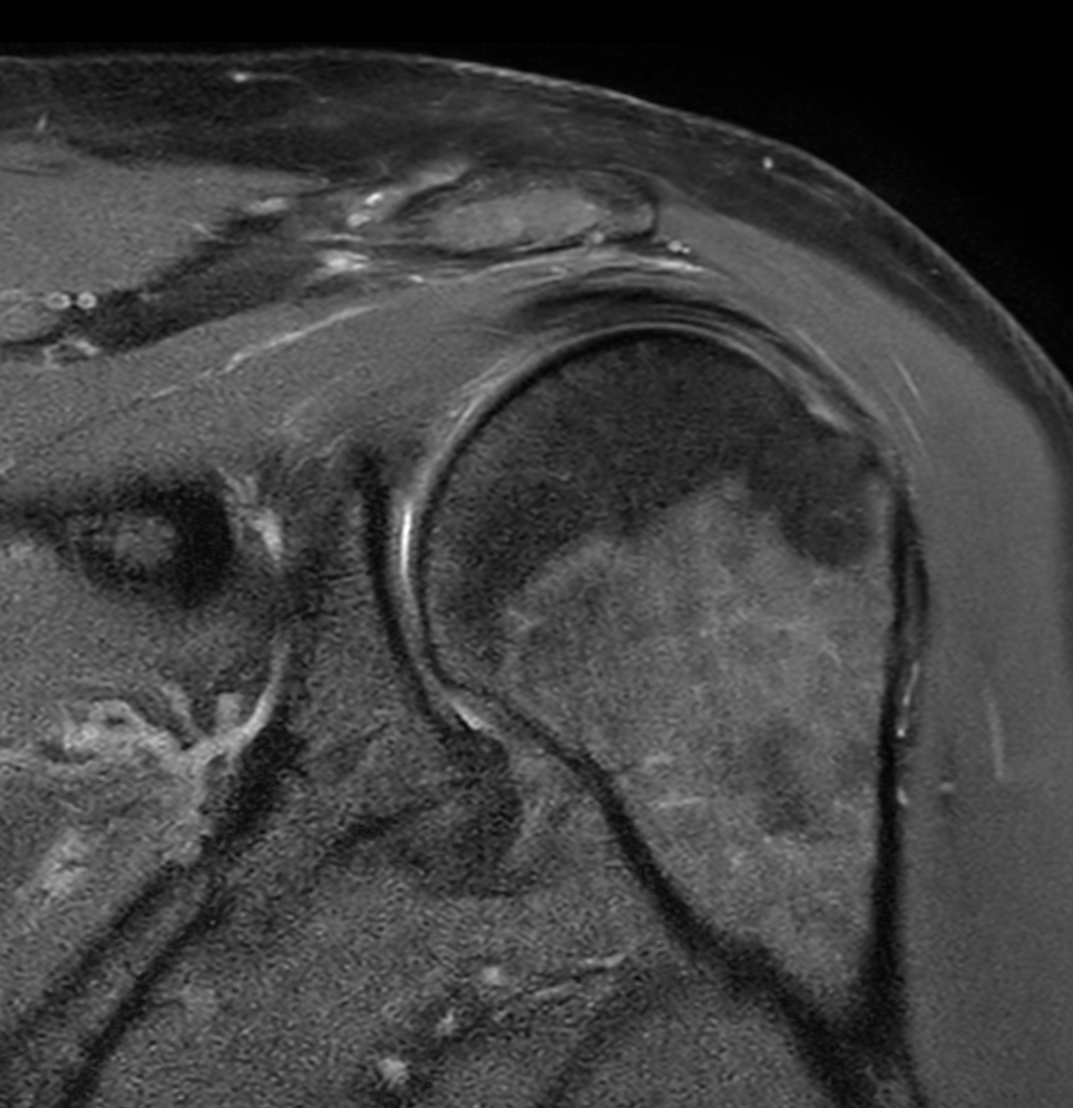 Coronal PDw aTSE mDIXON XD (Water only)