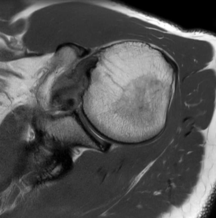 Shoulder imaging with the dS 16ch Shoulder coil Philips MR Body Map