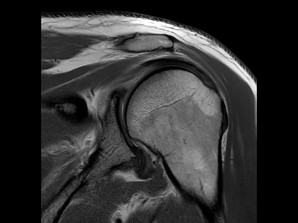 Coronal PDw aTSE