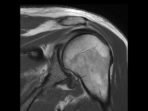 Motion-free shoulder imaging