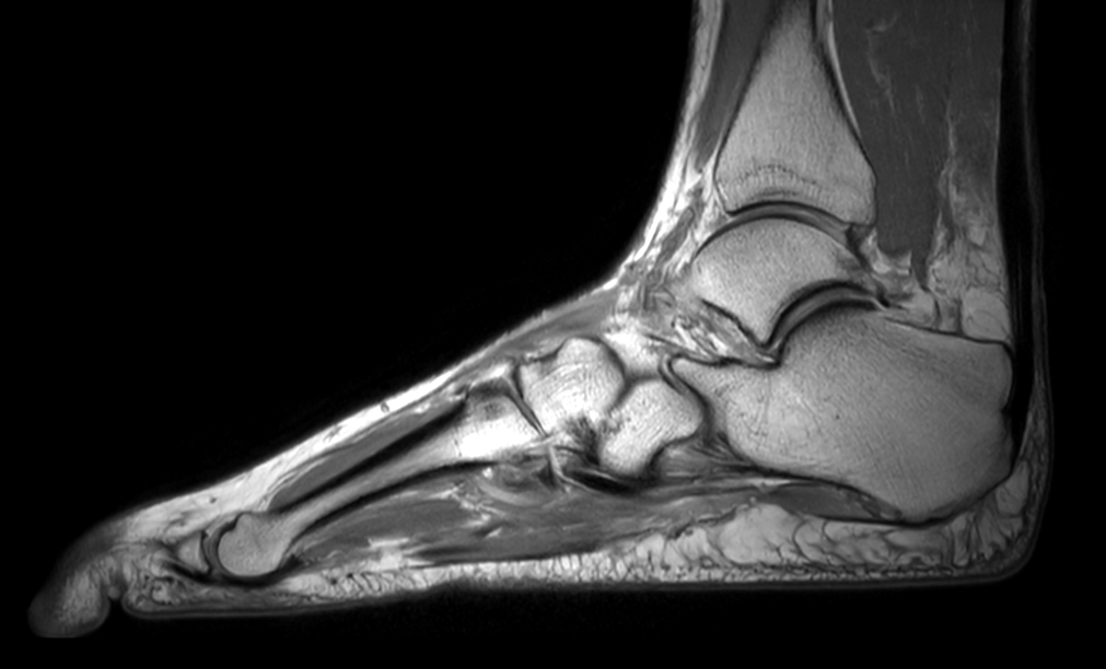 Sagittal PDw TSE mDIXON XD (In Phase)