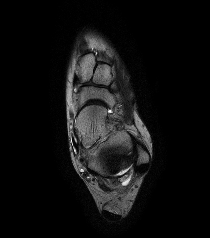 Axial Dual TSE - T2w 