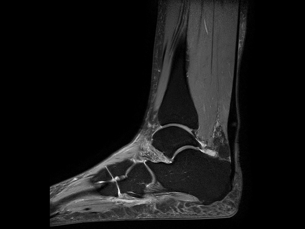 Sagittal PDw SPAIR