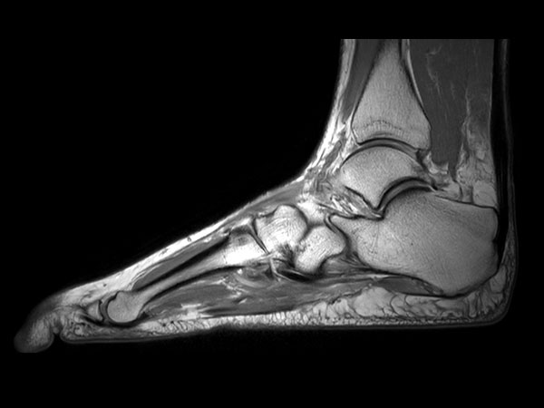 Sagittal PDw TSE mDIXON XD (In Phase)