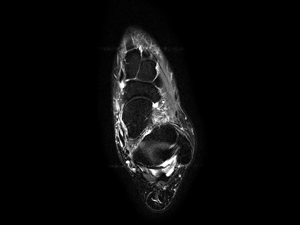 Axial STIR TSE 