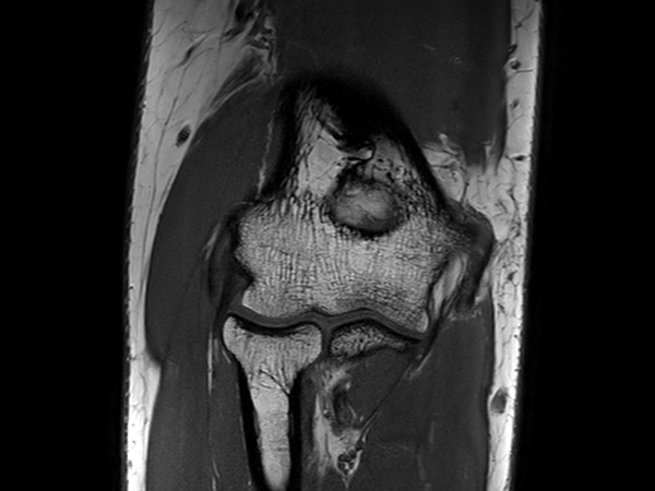 Coronal T1w TSE