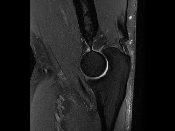 Sagittal PDw SPAIR