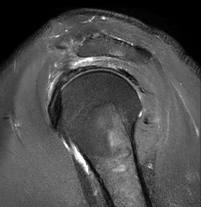 Sagittal T2w SPAIR with Compressed SENSE