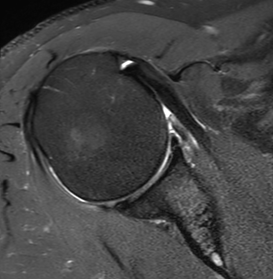 Axial T2w SPAIR with Compressed SENSE