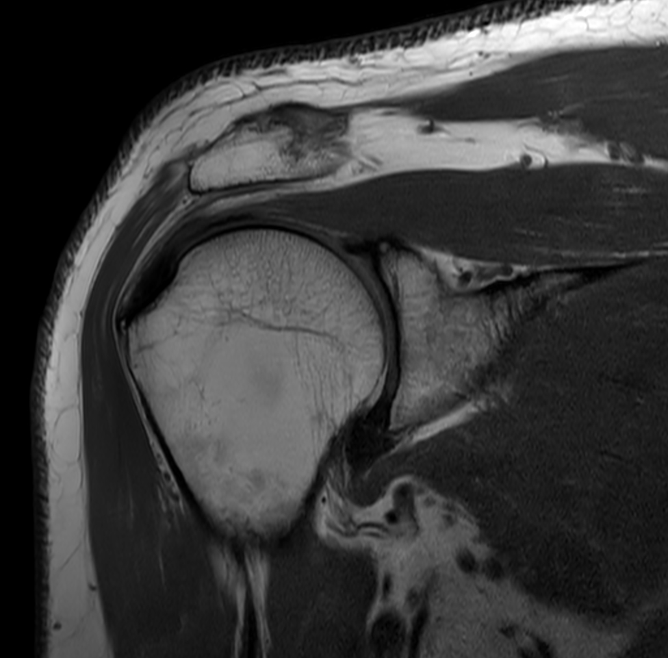 Coronal PDw TSE with Compressed SENSE