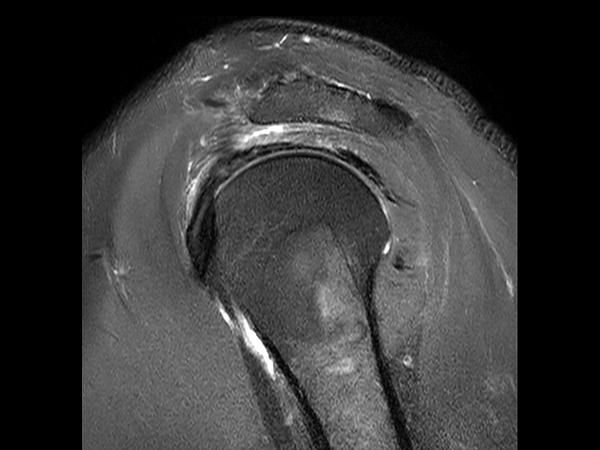 Sagittal T2w SPAIR with Compressed SENSE