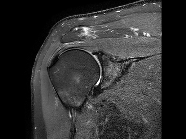 Coronal T2w SPAIR with Compressed SENSE