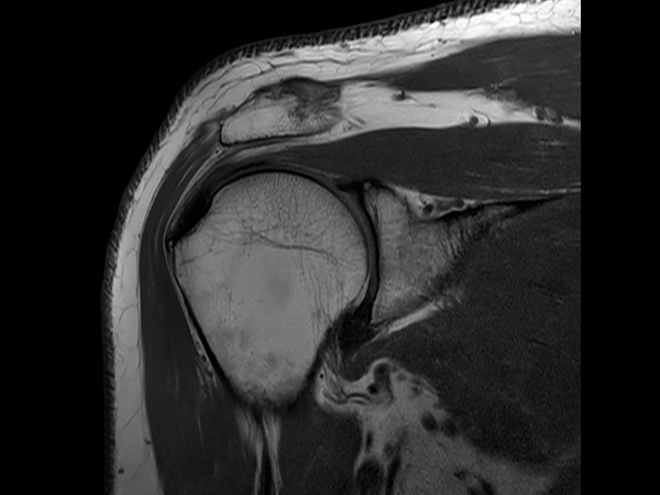 Coronal PDw TSE with Compressed SENSE