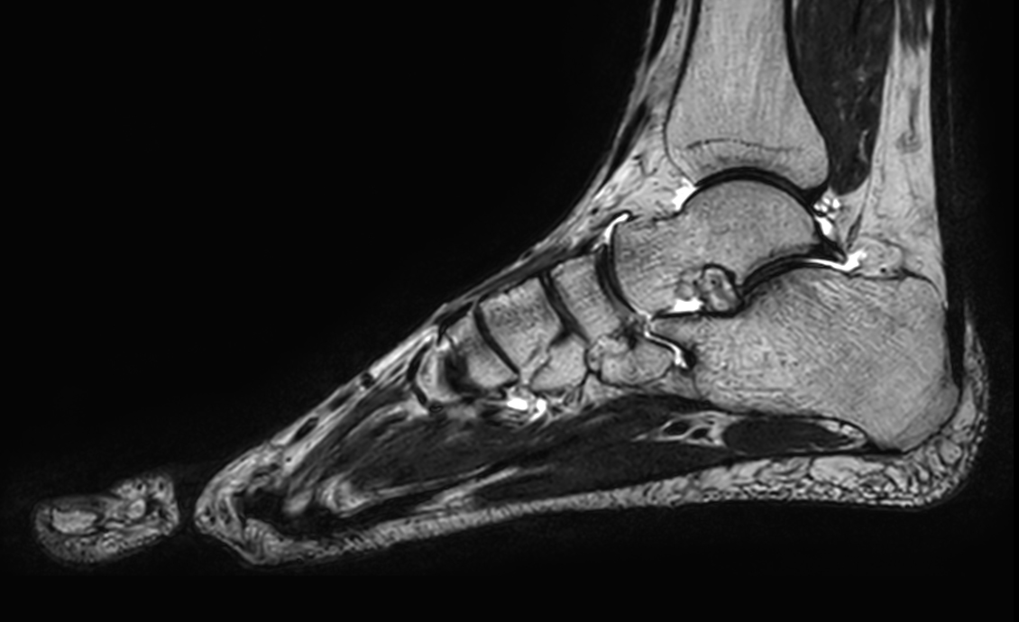 Sagittal 3D VIEW T2w TSE