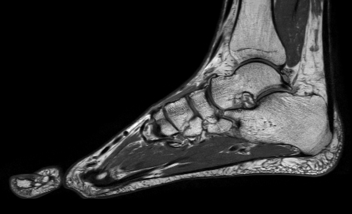 Sagittal 3D VIEW PDw TSE