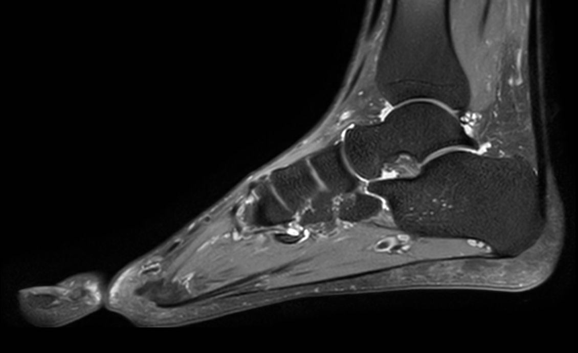 Sagittal 3D VIEW PDw SPAIR