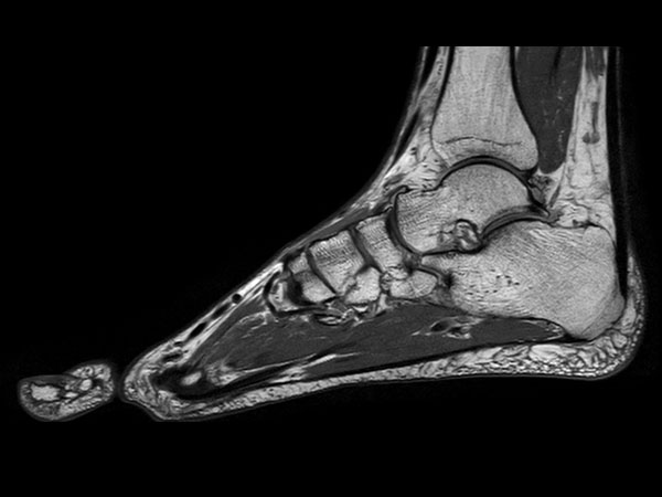 Sagittal 3D VIEW PDw TSE