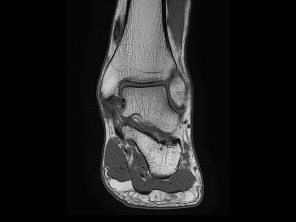 Coronal T1w TSE