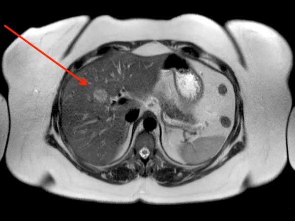 Axial T2w SSh TSE (Free Breath)