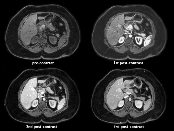Dynamic mDIXON (Water Only)