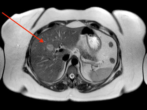 Axial T2w SSh TSE (Free Breath)