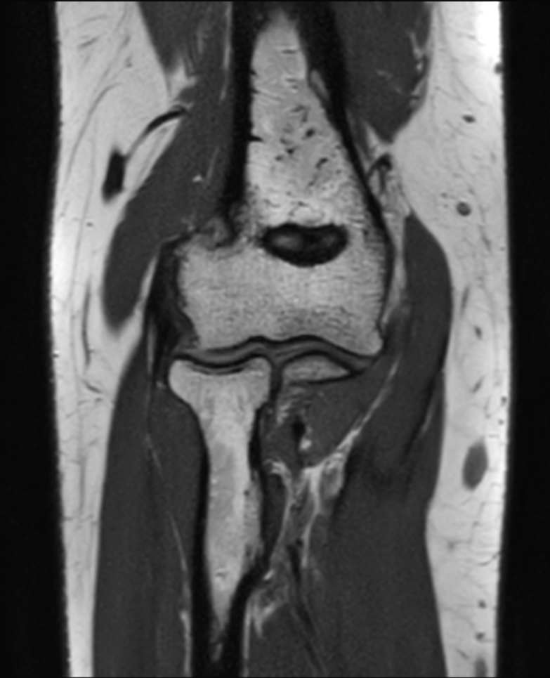 Coronal 3D VIEW PDw TSE